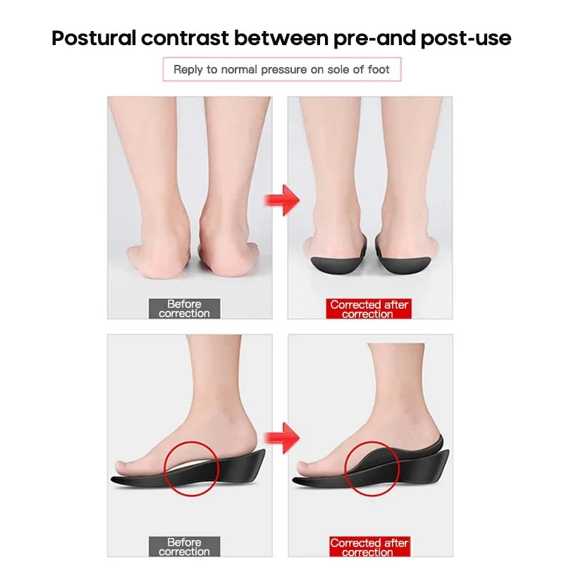 1Pair Flat foot O-shaped leg insoles (for shoes) Corrective arch